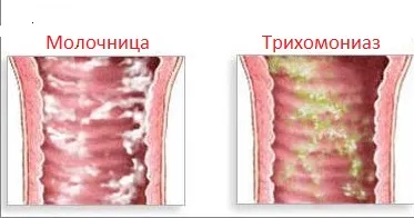 молочниці