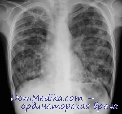 пренатальна діагностика муковісцидозу, вагітність при муковісцидозі пренатальна діагностика муковісцидозу