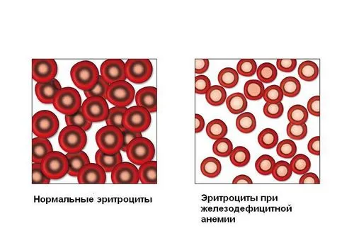що їсти вагітним при анемії що їсти вагітним при анемії