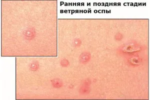 вітрянка у вагітних