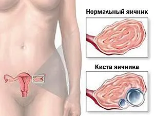 дермоїдна кіста яєчника і вагітність