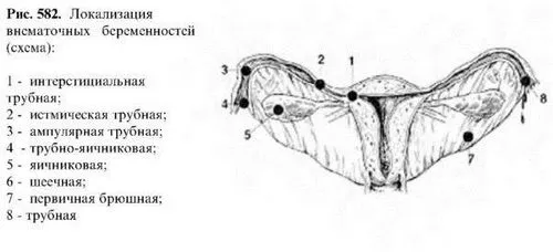 порушена позаматкова вагітність симптоми