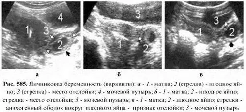порушена позаматкова вагітність симптоми