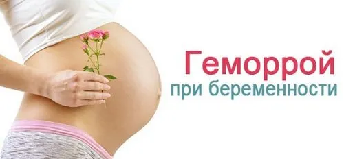 геморой у вагітних