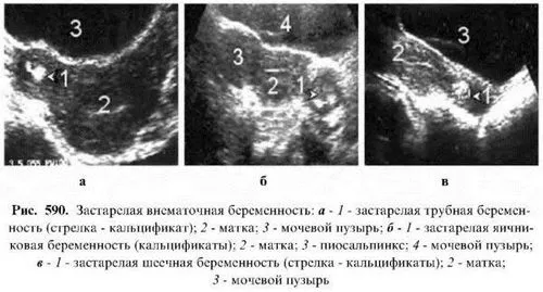 порушена позаматкова вагітність симптоми