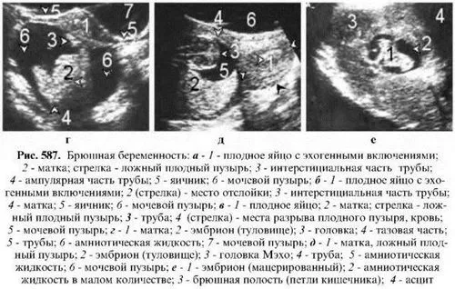 порушена позаматкова вагітність симптоми