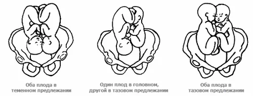 як визначити вагітність двійнею