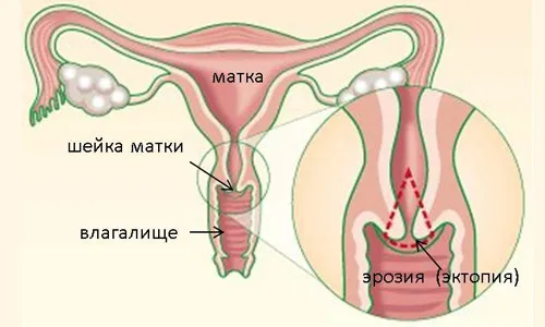 хвороби матки