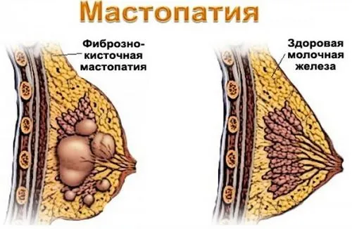 виділення під час вагітності з грудей виділення під час вагітності з грудей