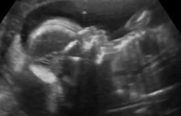 узі 32 тижня вагітності розшифровка плода ДПП показники товщина плаценти 12 дані другої таблиці 31 КТГ балів доплером норми результат