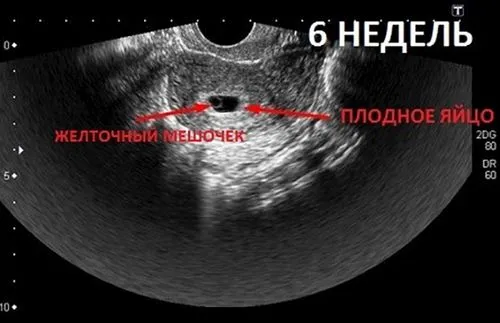 вагітність 6 тижнів узі