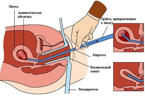 завмерла вагітність чистка
