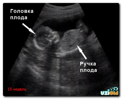 15 тижнів вагітності узі