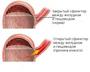 чи може бути печія при вагітності