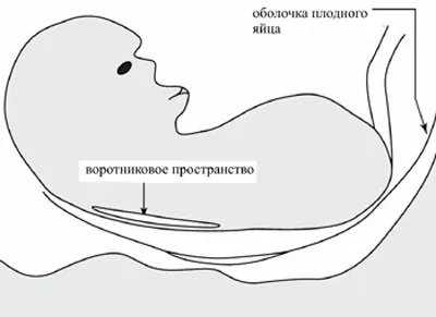 скринінг 1 триместру вагітності результат