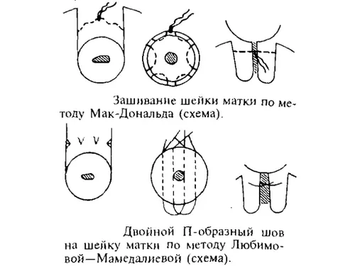 шийка матки при вагітності