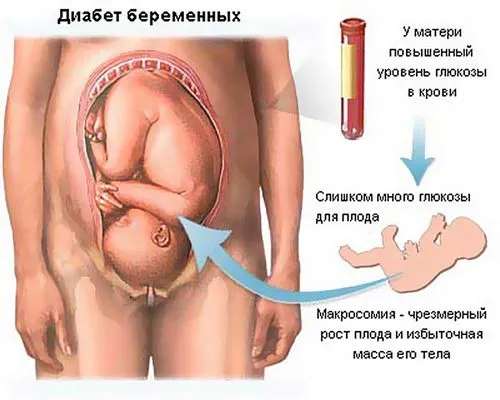 харчування вагітних при цукровому діабеті