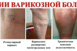 як уникнути варикозу під час вагітності