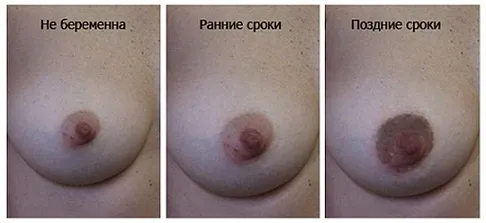 пігментація сосків під час вагітності