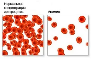 низький гемоглобін у вагітної