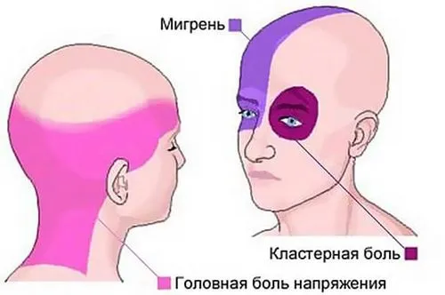 ніж зняти головний біль у вагітних