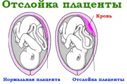 хвороби матки