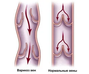 варикоз при вагітності