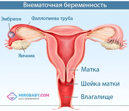 ознаки позаматкової вагітності