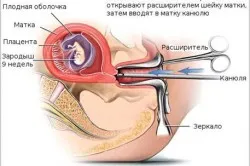 вагітність після аборту, перший по підлозі перший по підлозі