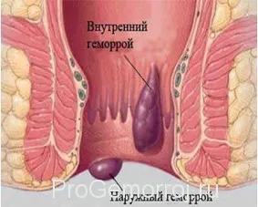 геморой у вагітних