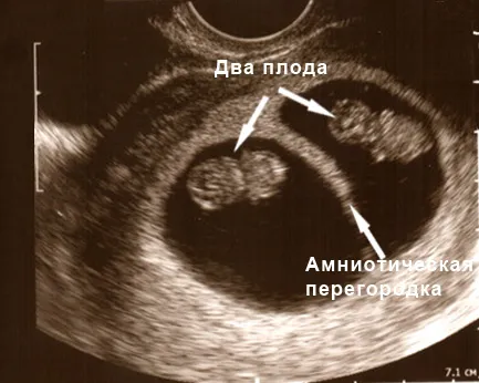 12 тиждень вагітності тягне живіт