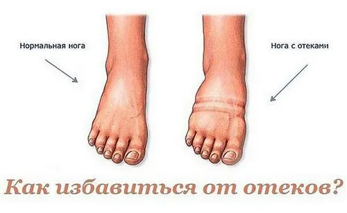 чому виникають набряки у вагітних