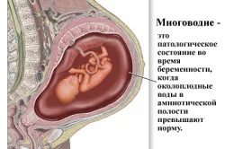многоводие у вагітних