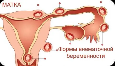 перші ознаки позаматкової вагітності