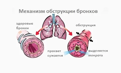 перший по бронхіту