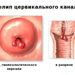 як перервати вагітність уколами