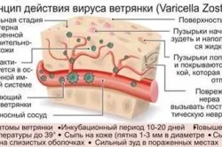 вітрянка під час вагітності
