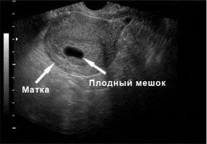 5 тиждень вагітності узі