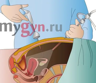 лапароскопія вагітність