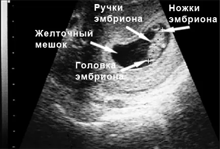 восьмий тиждень вагітності