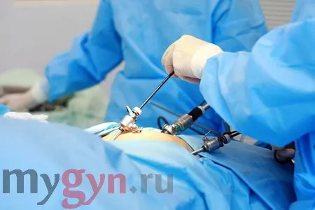 як швидко завагітніти після лапароскопії