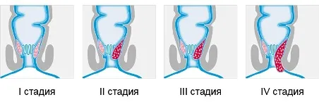 геморой, після пологів, лікування, лікувати, причини, симптоми, ознаки, стадії, способи, методи, засоби, харчування, гімнастика, профілактика, здоров'я стадії