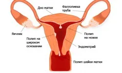 поліп на шийки матки під час вагітності