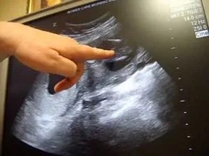 стать дитини на УЗД