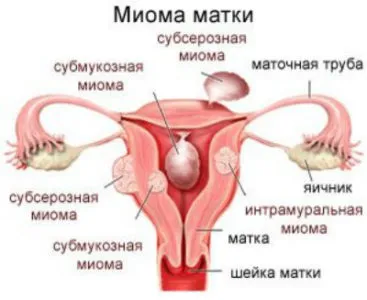 міома матки при вагітності