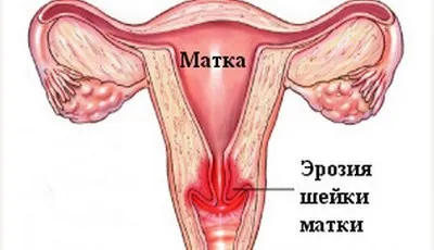 припікання ерозії шийки матки відео