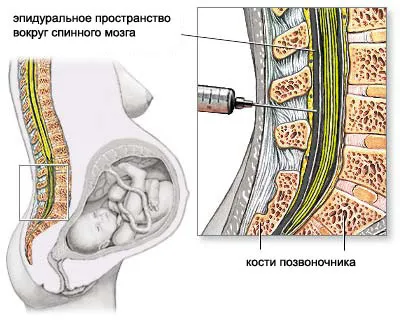 другі пологи після кесарева