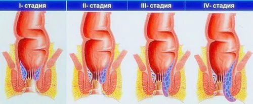 як лікувати геморой у вагітних