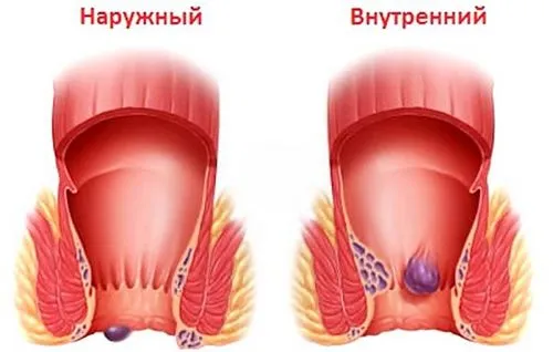 зовнішній геморой при вагітність мазь лікування фото домашні умови лікувати позбутися свічки кровит гострий