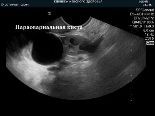 кіста яєчника і вагітність